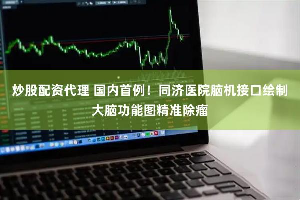 炒股配资代理 国内首例！同济医院脑机接口绘制大脑功能图精准除瘤